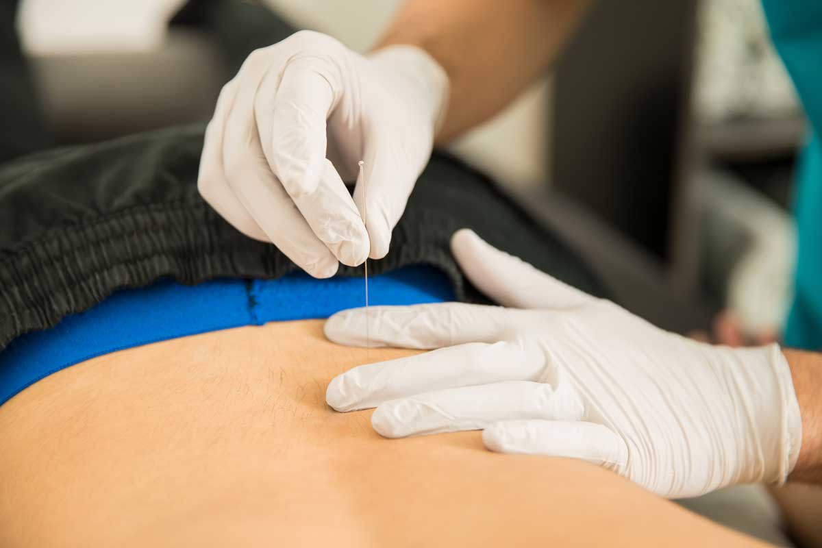 Dry needling at Quinnipiac Physical Therapy & Sports Medicine